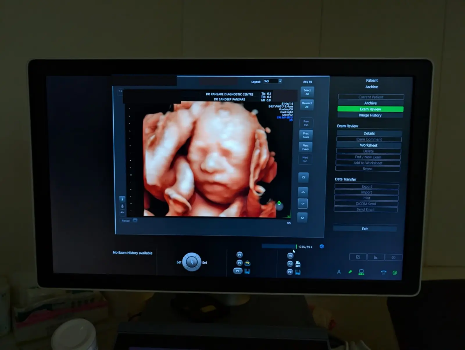 A three-dimensional ultrasound image of a baby on the scanner at the centre